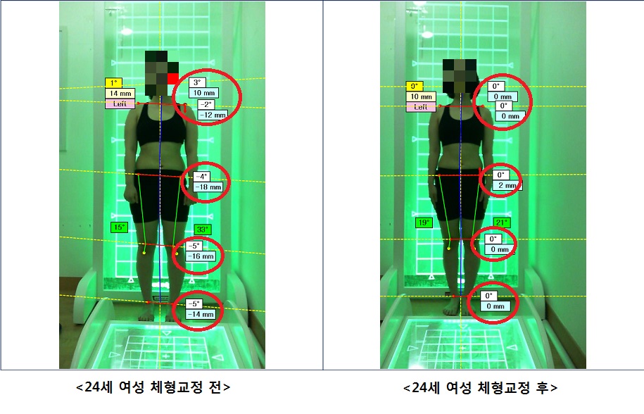 24세 여성 체형교정 전.후