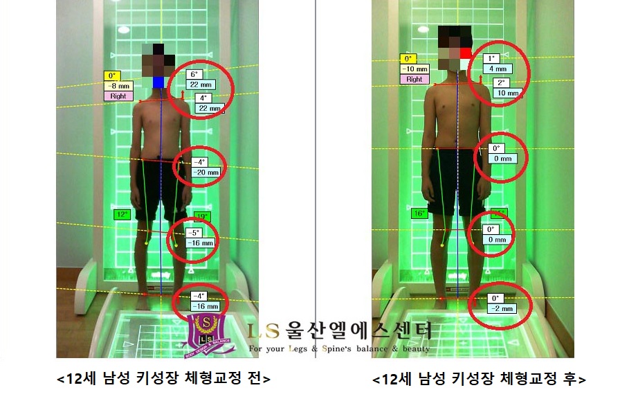 12세 남성 키성장 체형교정 전.후