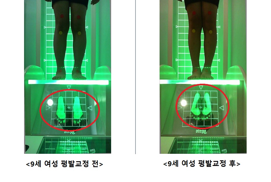 9세 여성 평발교정 전.후