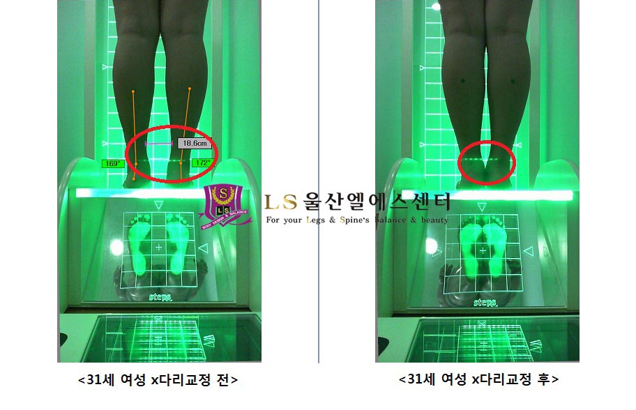 31세 여성 x다리교정 전.후