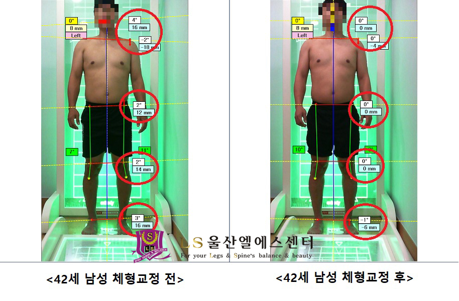 42세 남성 체형교정 전.후