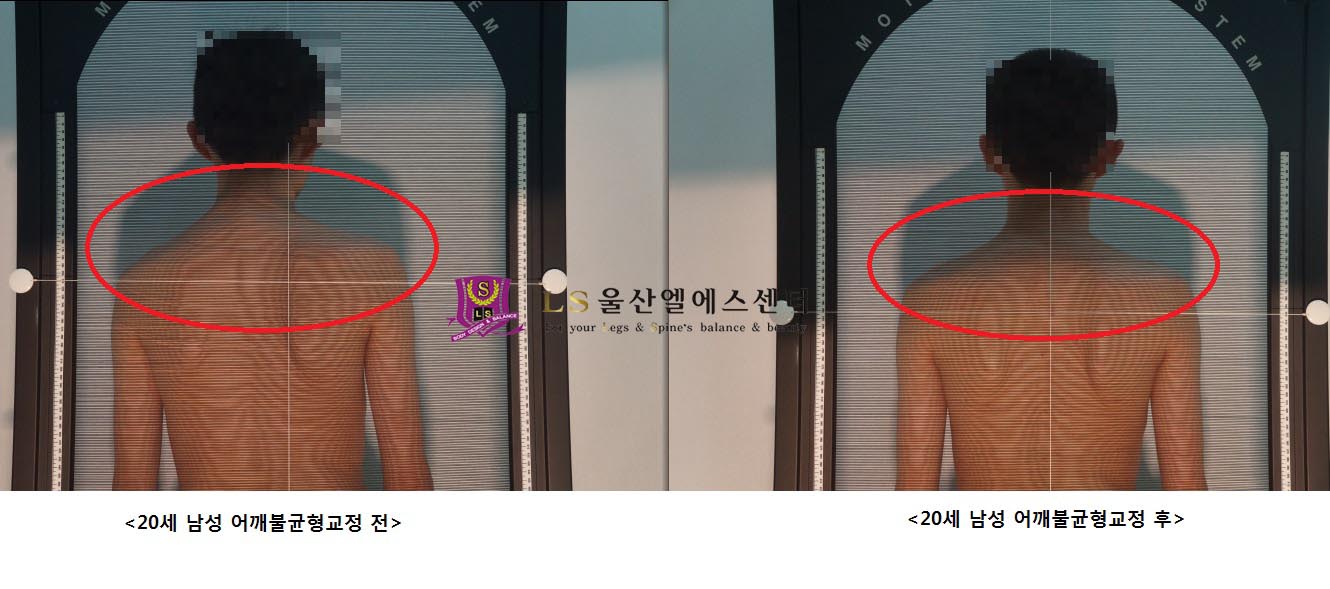 20세 남성 어깨불균형교정 전.후