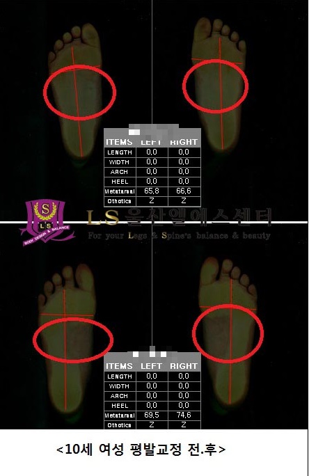 10세 여성 평발교정 전.후