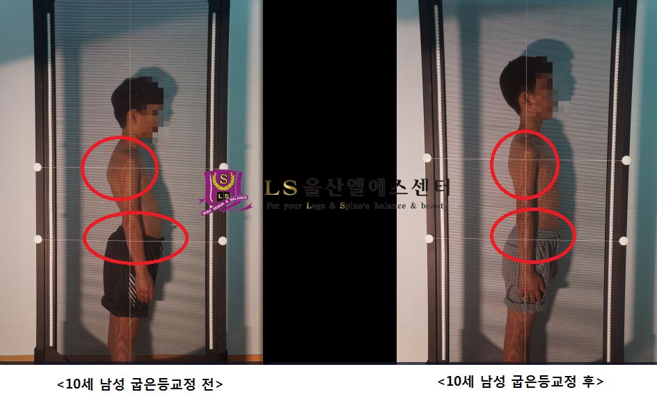 10세 남성 거북목 굽은등 교정 전.후