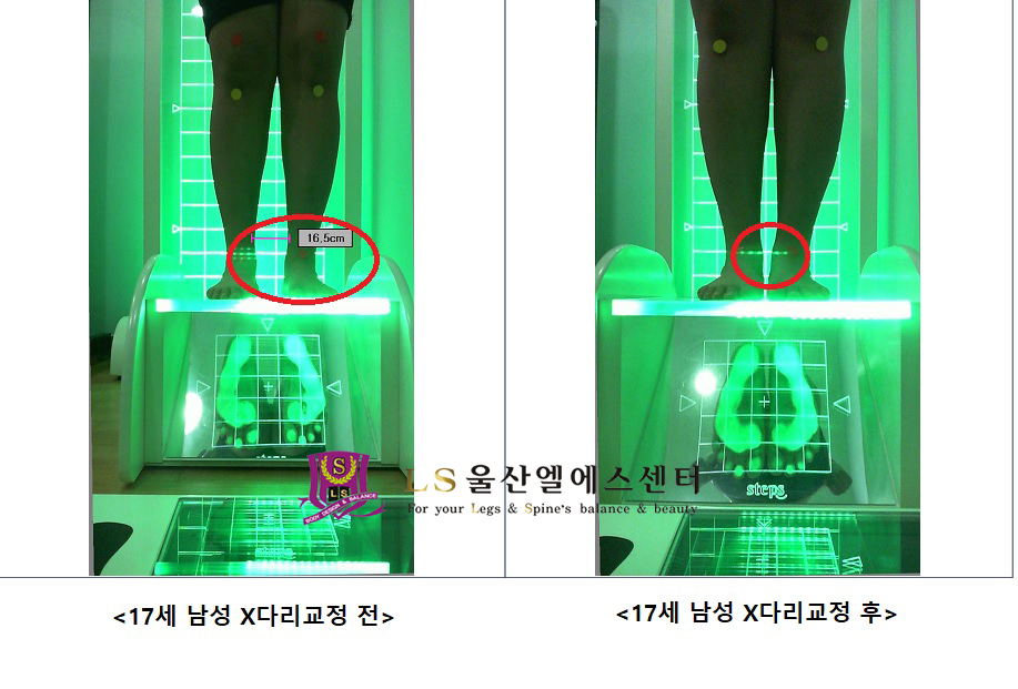 17세 남성 x다리교정 전.후