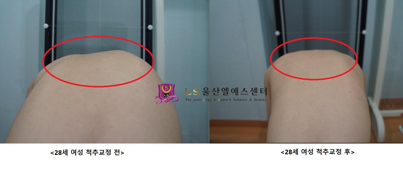 28세 여성 척추교정 전.후