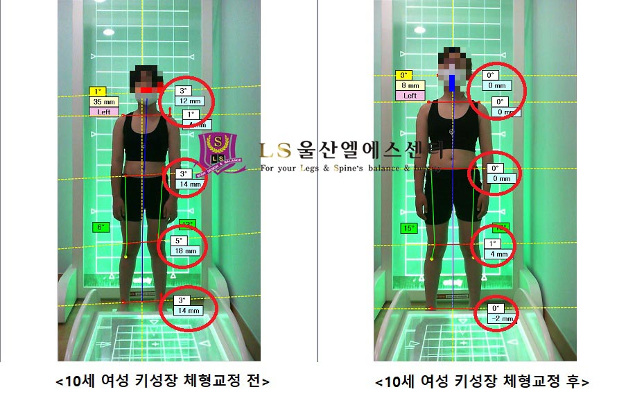 10세 여성 키성장 체형교정 전.후