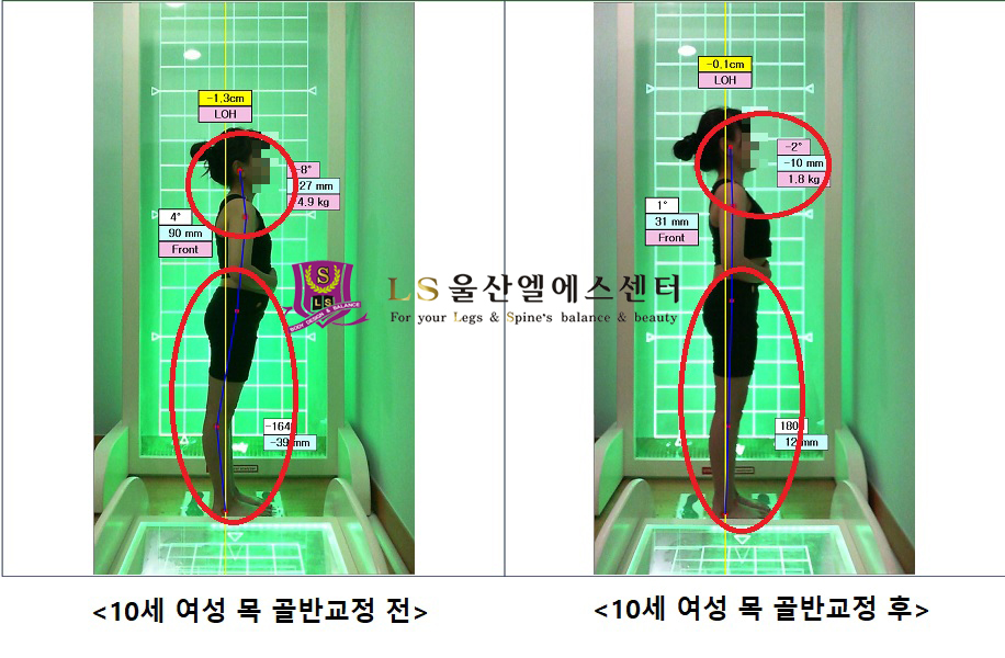 10세 여성 목 골반교정 전.후
