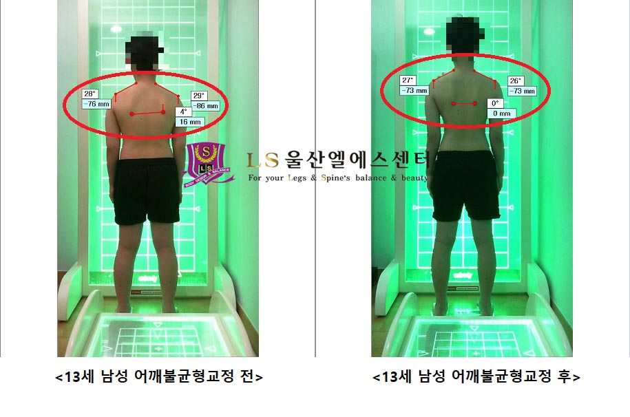 13세 남성 어깨불균형교정 전.후