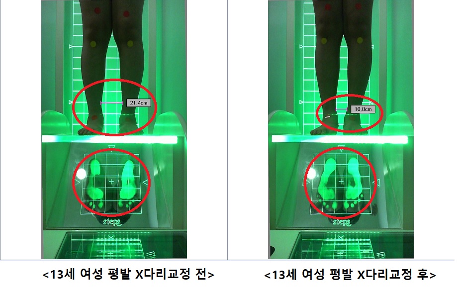 13세 여성 평발 x다리교정 전.후