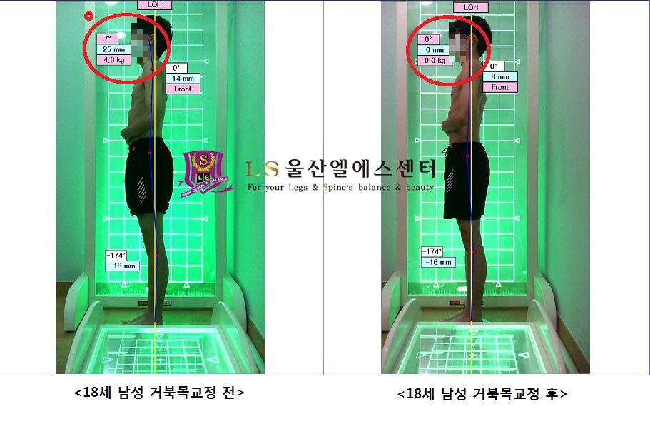 18세 남성 거북목교정 전.후