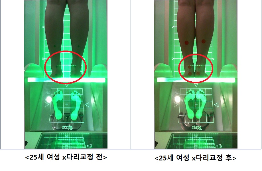 25세 여성 x다리교정 전.후