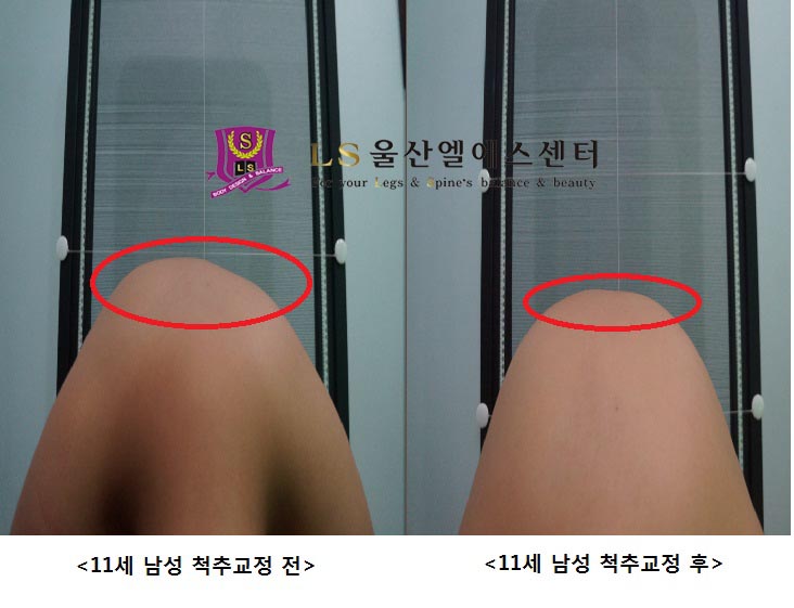 11세 남성 척추교정 전.후