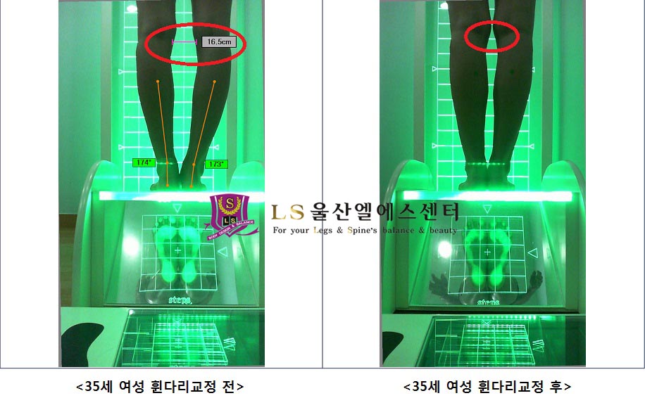 35세 여성 휜다리교정 전.후