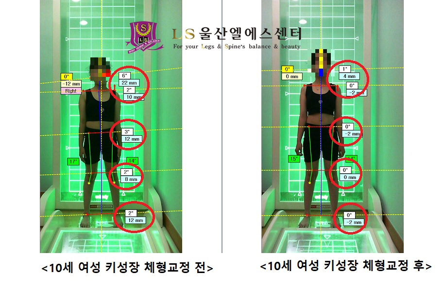 10세 여성 키성장 체형교정 전.후