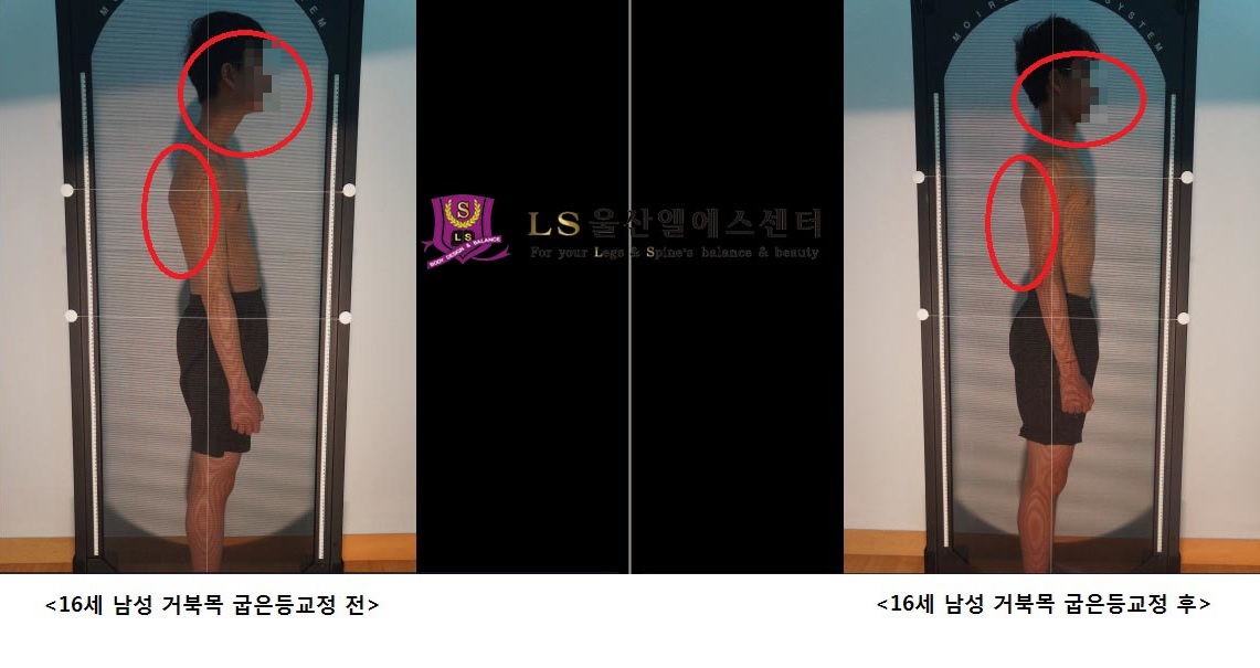 16세 남성 목 골반교정 전.후