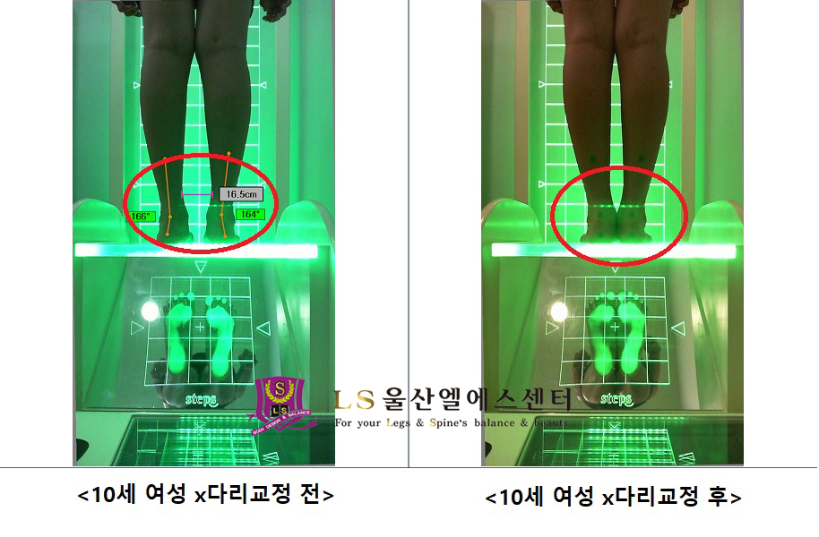10세 여성 x다리교정 전.후