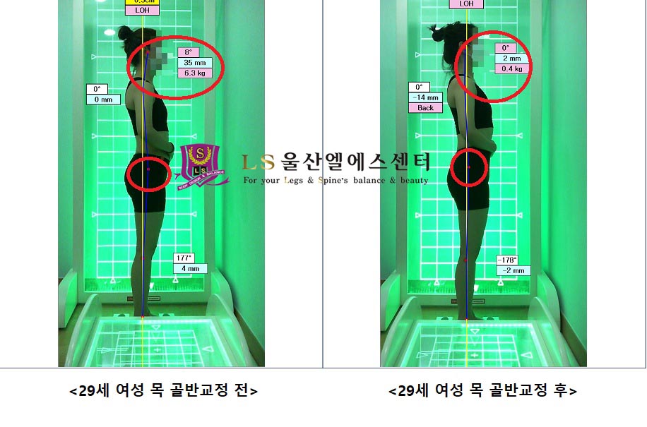 29세 여성 목 골반교정 전.후