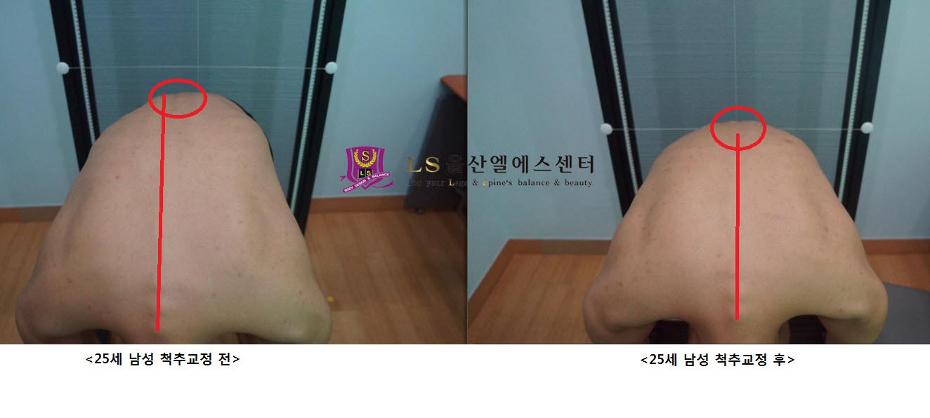 25세 남성 척추교정 전.후