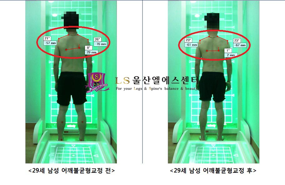 29세 남성 어깨불균형교정 전.후