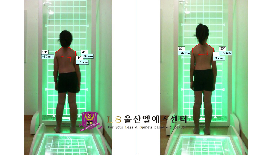 13세 여성 키성장 척추교정 전.후