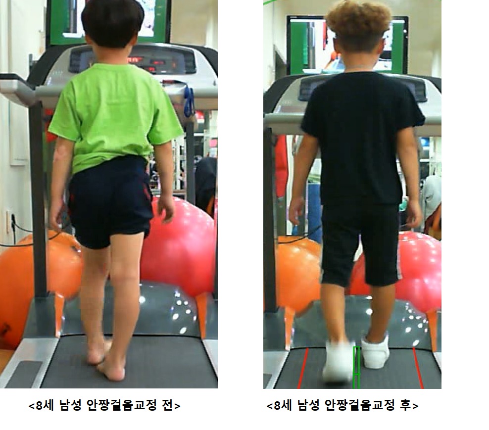 8세 남성 안짱걸음교정 전.후