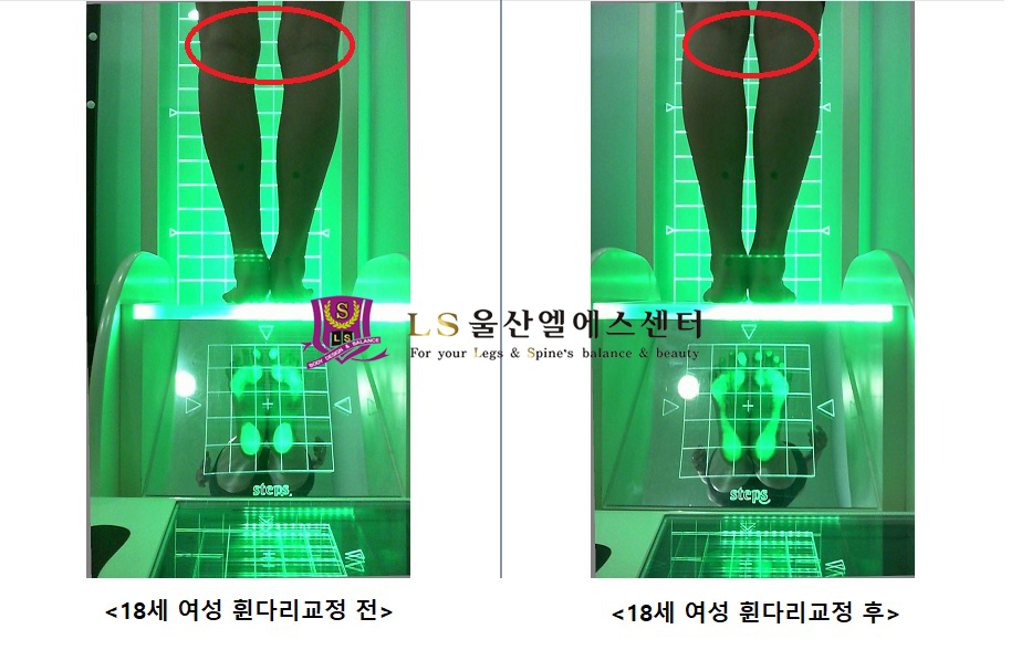 18세 여성 휜다리교정 전.후