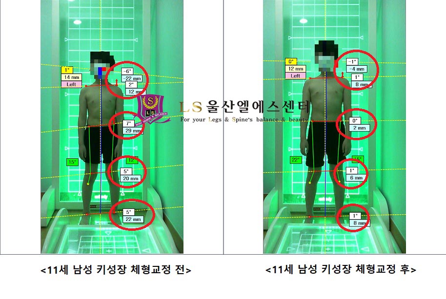 12세 남성 키성장 체형교정 전.후