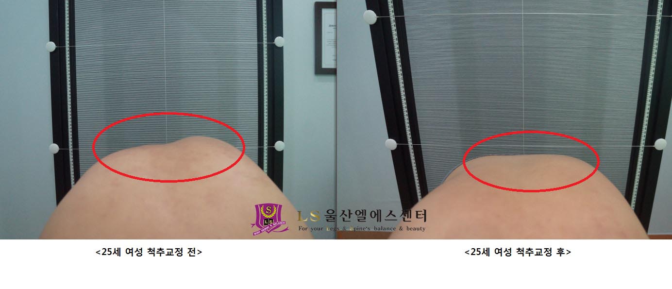 25세 여성 척추교정 전.후
