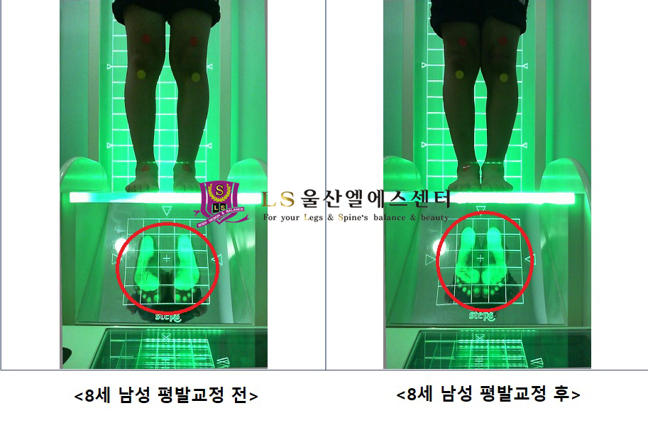 8세 남성 평발교정 전.후