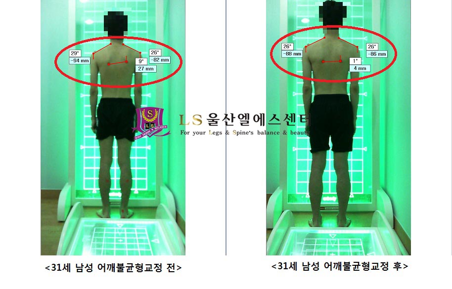 31세 남성 어깨불균형교정 전.후