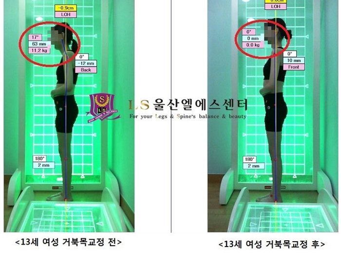 13세 여성 거북목교정 전.후