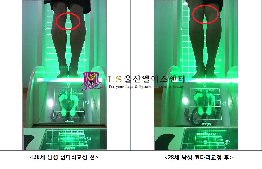 28세 남성 휜다리교정 전.후