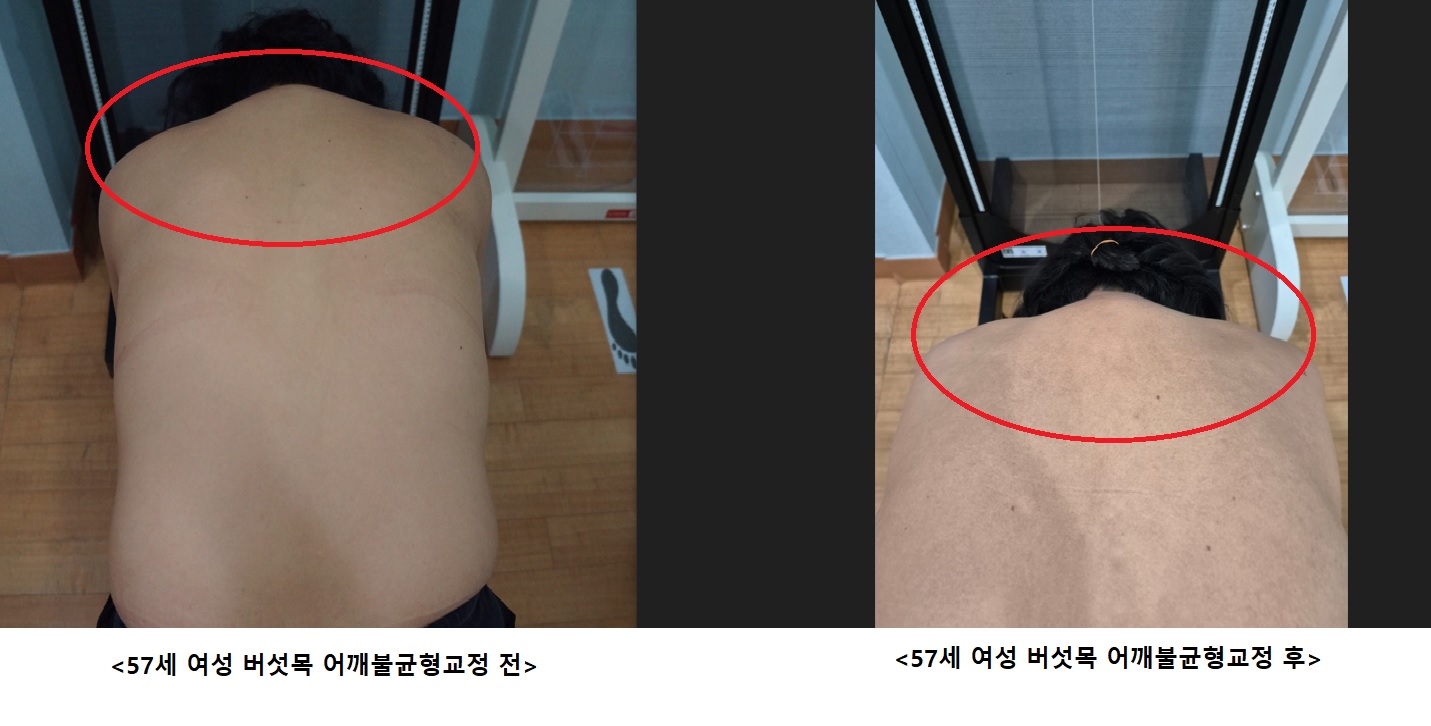 57세 여성 버섯목  어깨불균형 교정 전.후