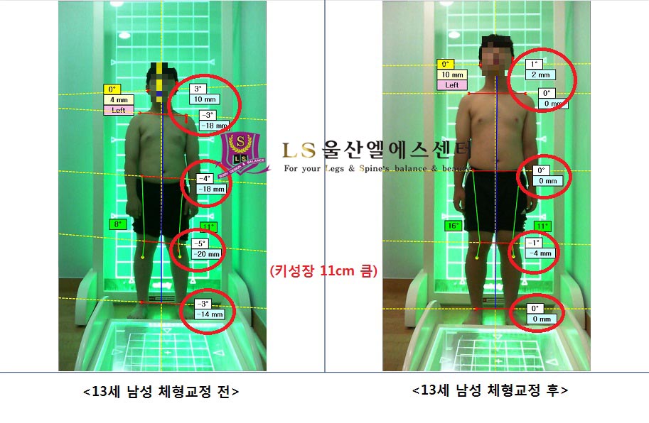 13세 남성 키성장 체형교정 전.후
