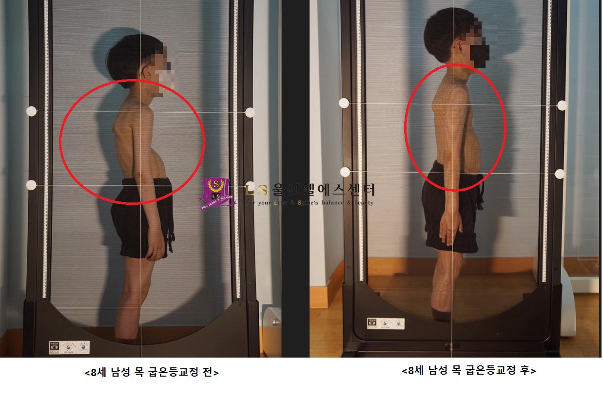 8세 남성 거북목 굽은등 교정 전.후