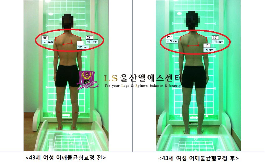 43세 여성 어깨불규형교정 전.후