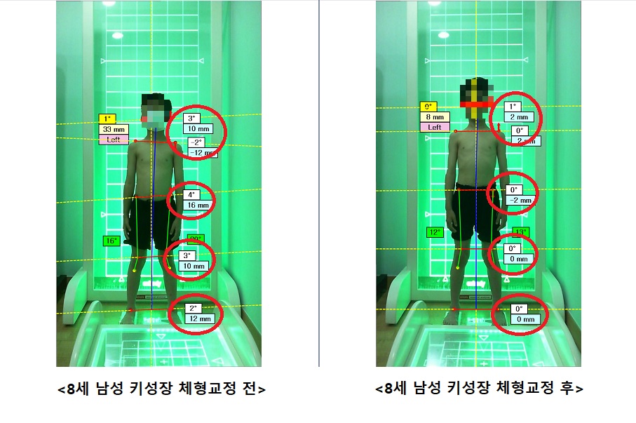 8세 나성 키성장 체형교정 전.후