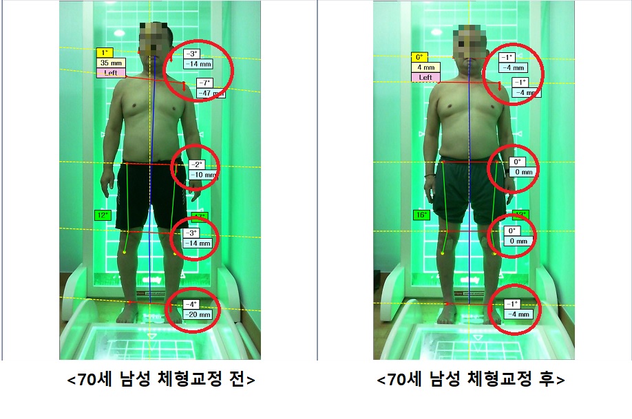 70세 남성 체형교정 전.후