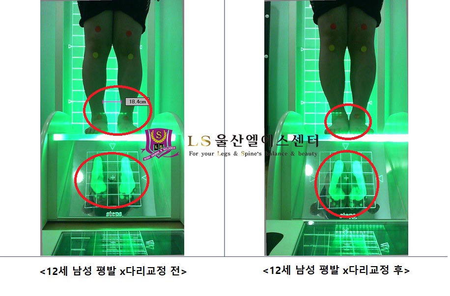 12세 남성 평발 x다리교정 전.후