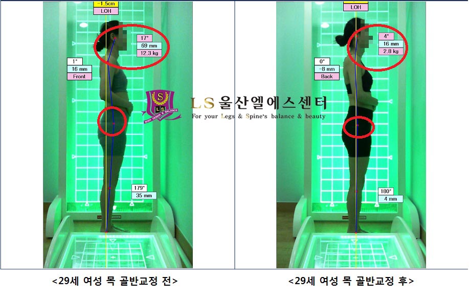 29세 여성 목 골반교정 전.후