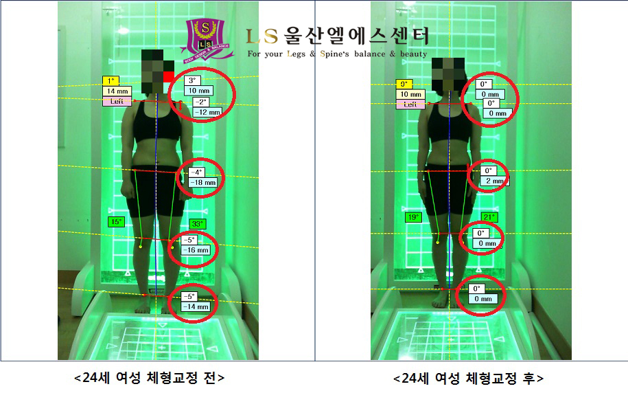 24세 여성 체형교정 전.후