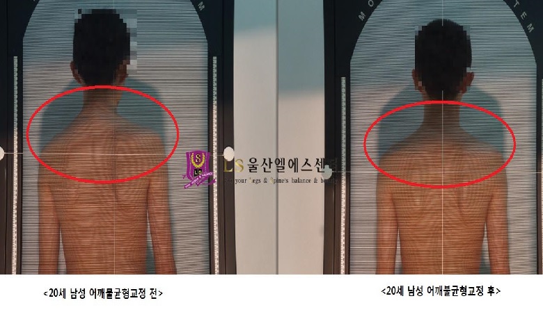 20세 남성 어깨불균형교정 전.후