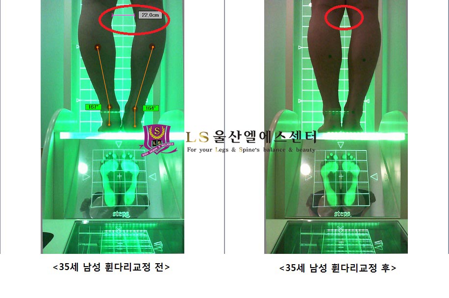 35세 남성 휜다리교정 전.후