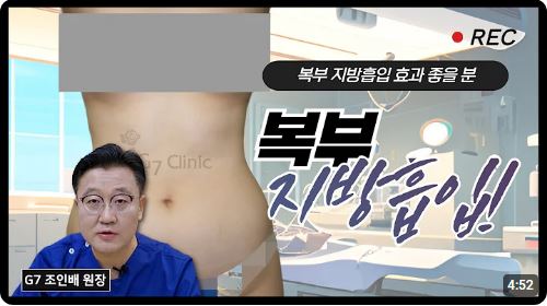 복부 지방흡입(효과 좋을 케이스)