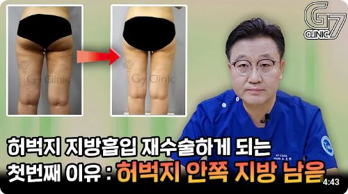 허벅지 지방흡입 재수술 하게 되는 첫 번째 이유