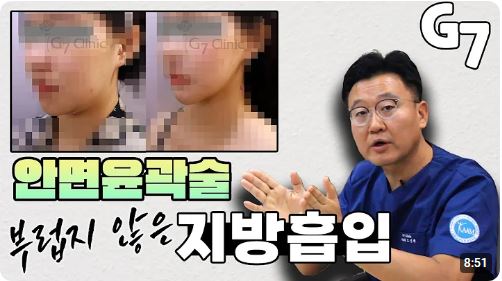 안면윤곽술 부럽지 않은 지방흡입