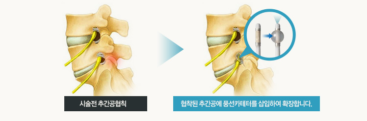 시술전 추간공협칙 → 협착된 추간공에 풍선카테터를 삽입하여 확장합니다.