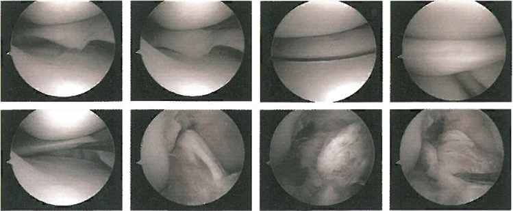 관절내시경을 이용한 파열된 무릎 연골 봉합