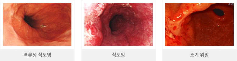 역류성 식도염, 식도암, 조기 위암